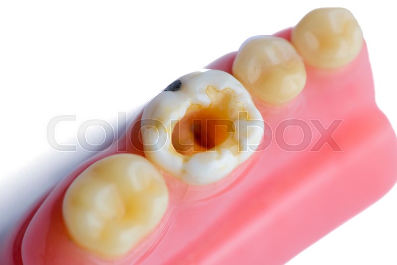 real decay molar teeth model stock photo colourbox