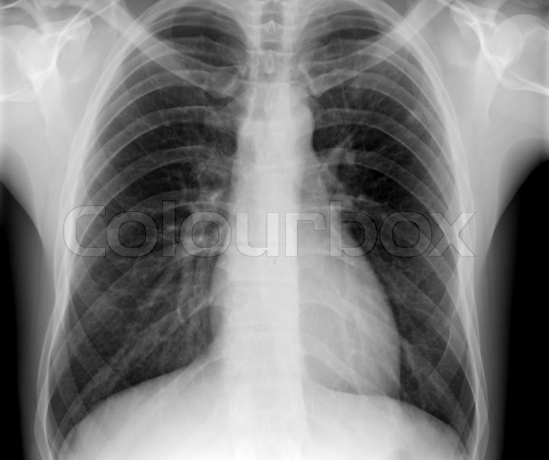 X-ray of chest of healthy patient | Stock Photo | Colourbox