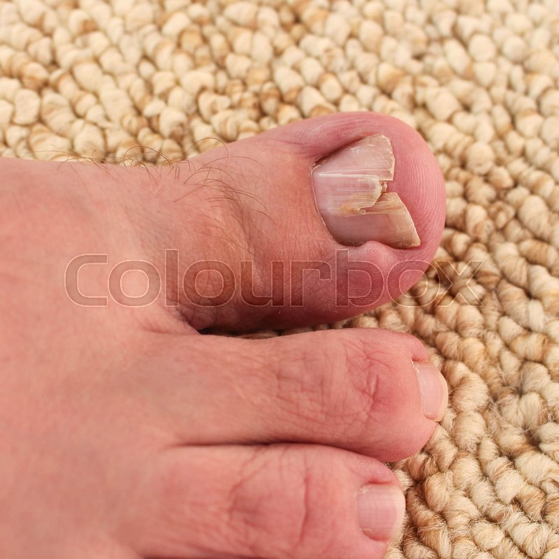 Damaged toenail Stock image Colourbox