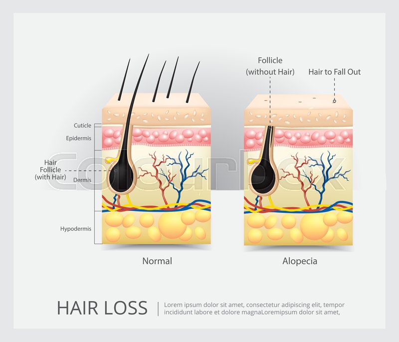 Hair Loss Structure Vector Stock Vector Colourbox