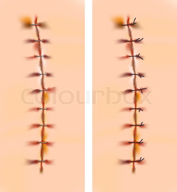 Scars with staples and sutures Stock Vector Colourbox